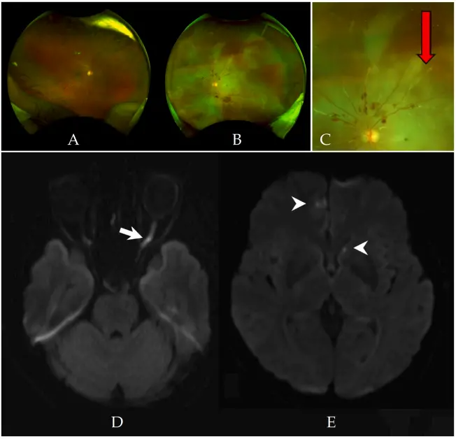 童顏針（PDLLA），又一例栓塞致盲案例來(lái)了