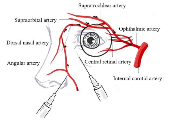 童顏針（PDLLA），又一例栓塞致盲案例來(lái)了