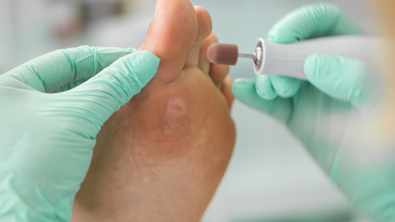 小孩子長雞眼不處理