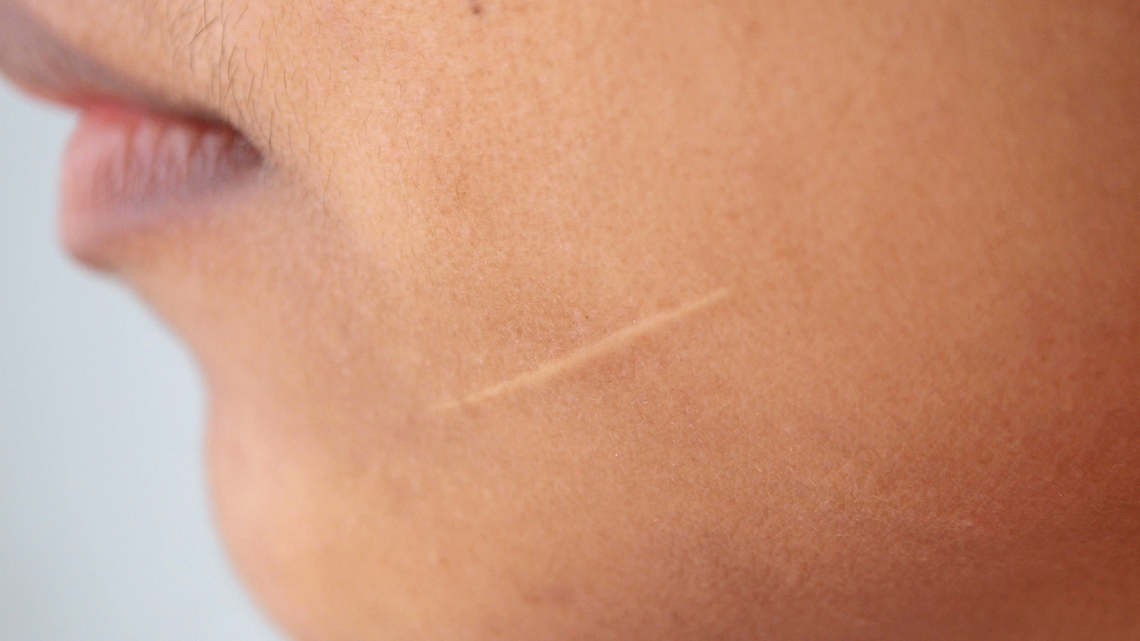 腋下狐臭手術(shù)疤痕怎么修復(fù)