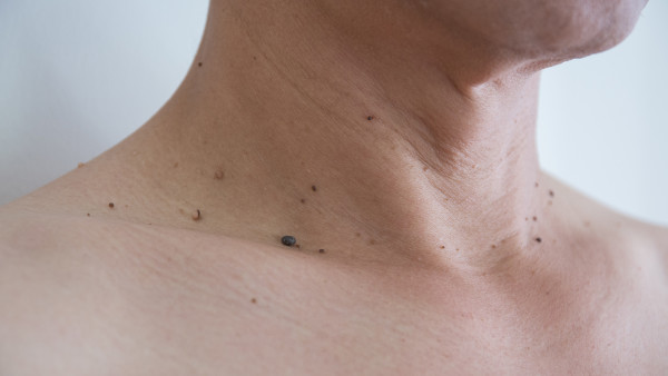 尋常疣用什么藥膏除根雞眼