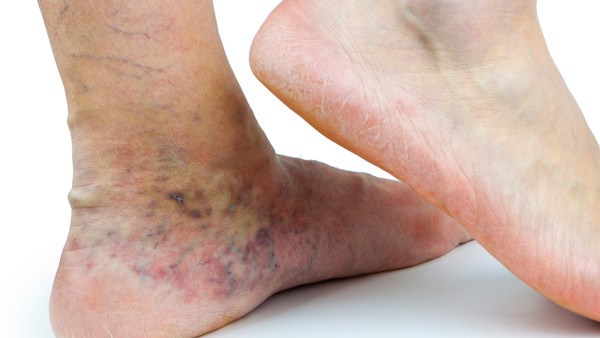 腳趾痛風(fēng)，紅腫該吃什么藥