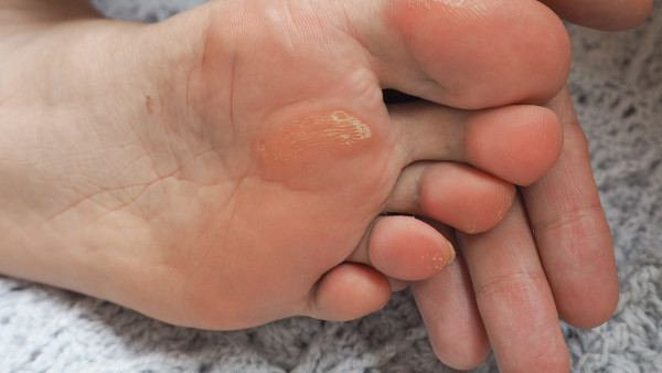 怎么看寶寶是對雞眼