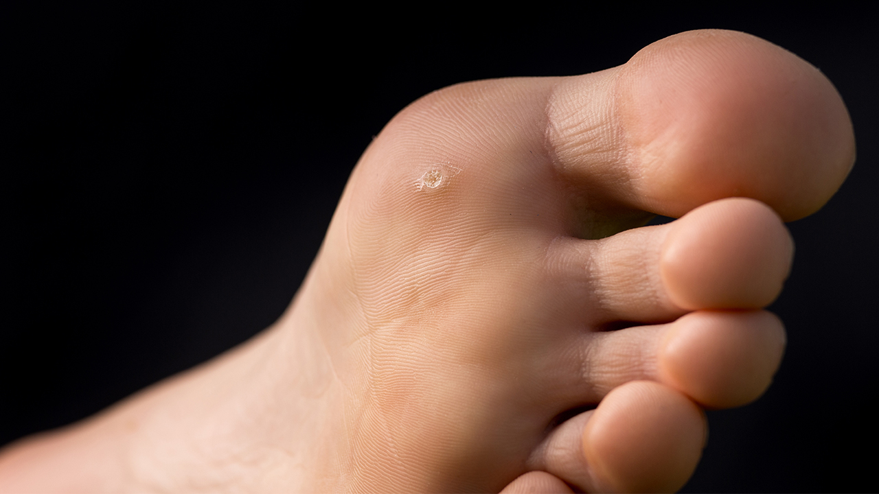 血包刺能用雞眼膏嗎