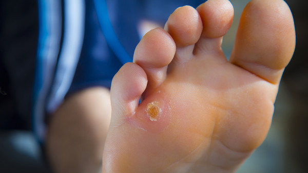 小猴子和雞眼的區(qū)別