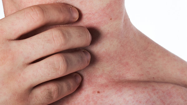 臉過敏怎么就成紅斑狼瘡了