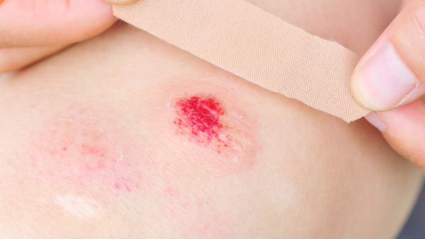 得登革熱后皮下出血怎么辦