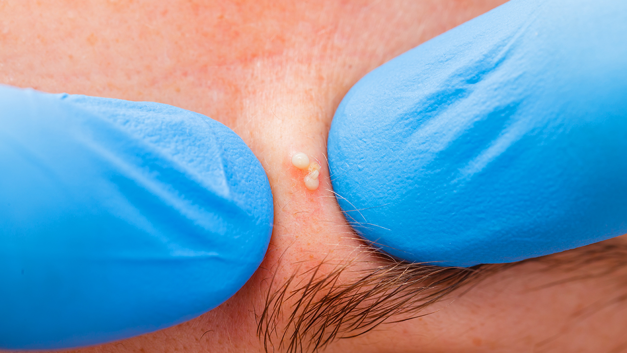 長痘痘是內分泌失調了了嗎