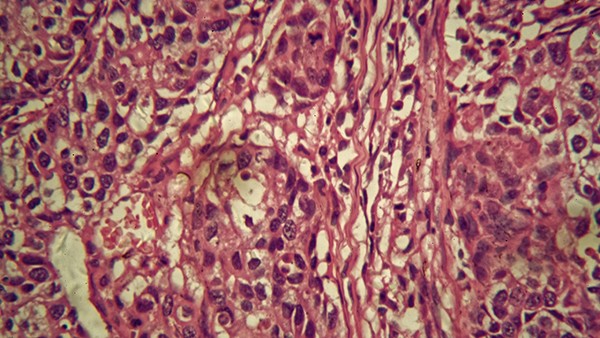 心慌頭暈是新型冠狀病毒嗎