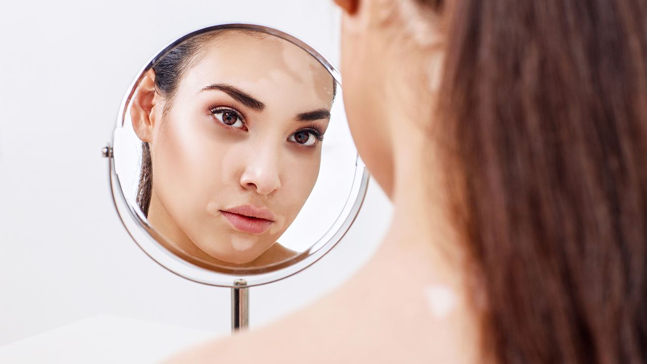 腳部白癜風(fēng)初期如何治療