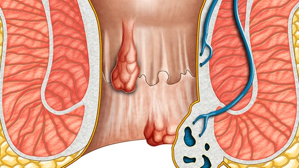 低鉀血癥是尿毒癥前兆嗎