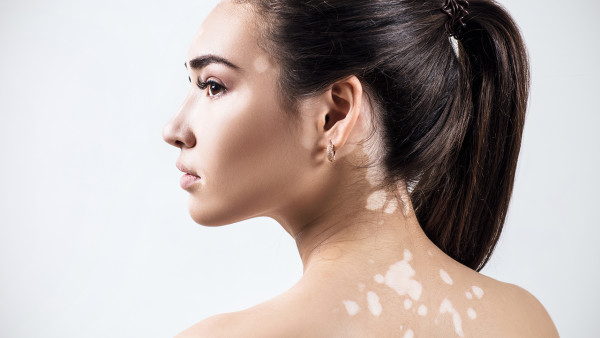 北京治療白癜風哪里安全