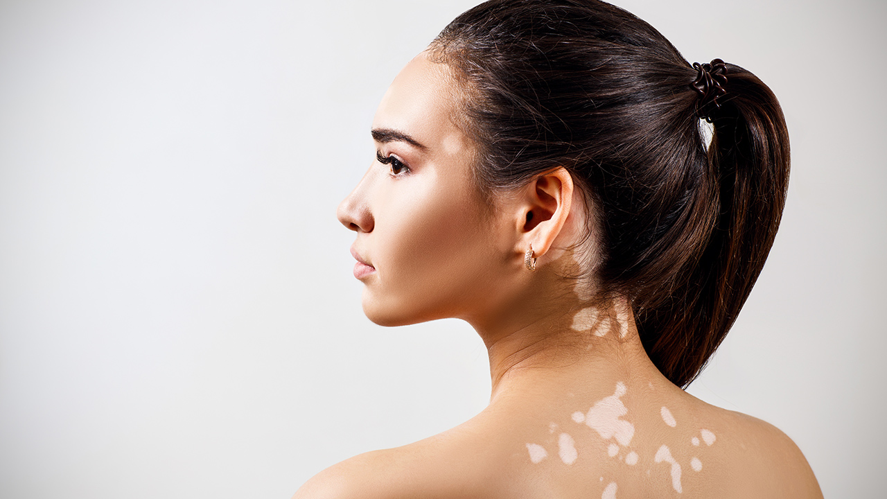 白癜風(fēng)會自己主動消失嗎