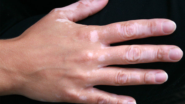 哪些傷害是白癜風(fēng)造成的