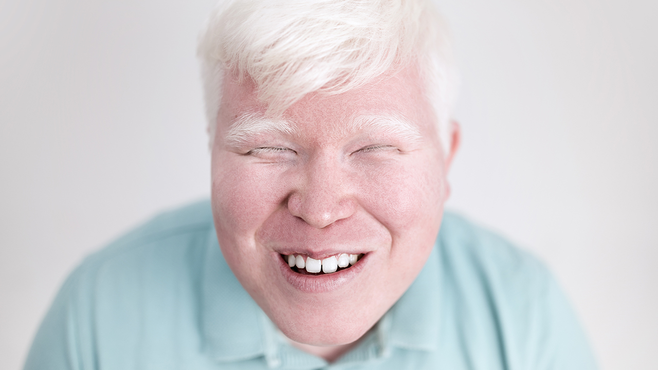 白化病智力下降速度快嗎