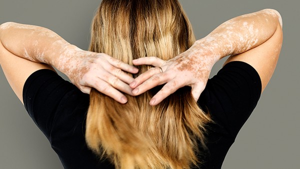 如何預(yù)防白癜風(fēng)的出現(xiàn)呢