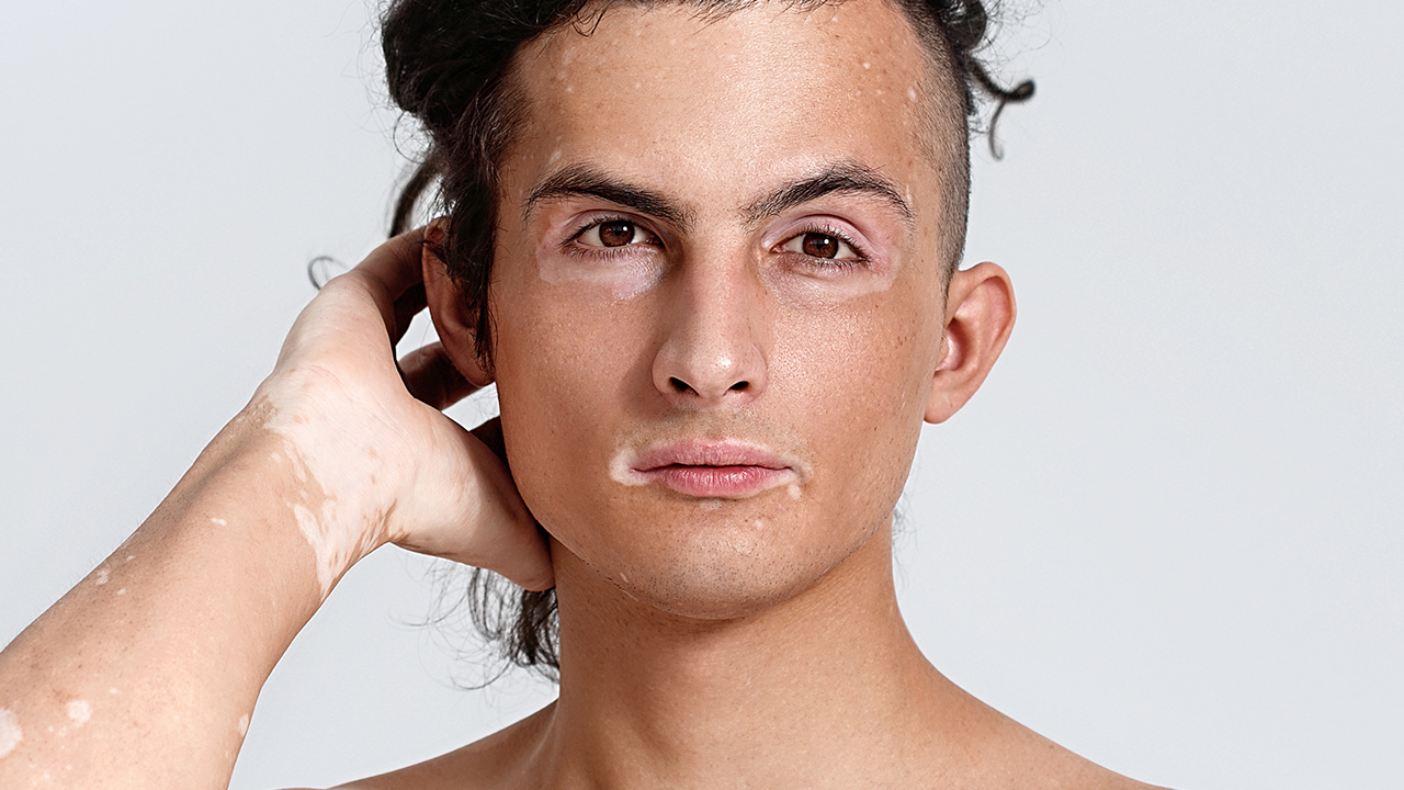 冬季治療白癜風(fēng)效果好嗎