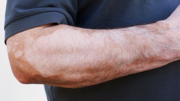 治療白癜風(fēng)是需要住院嗎