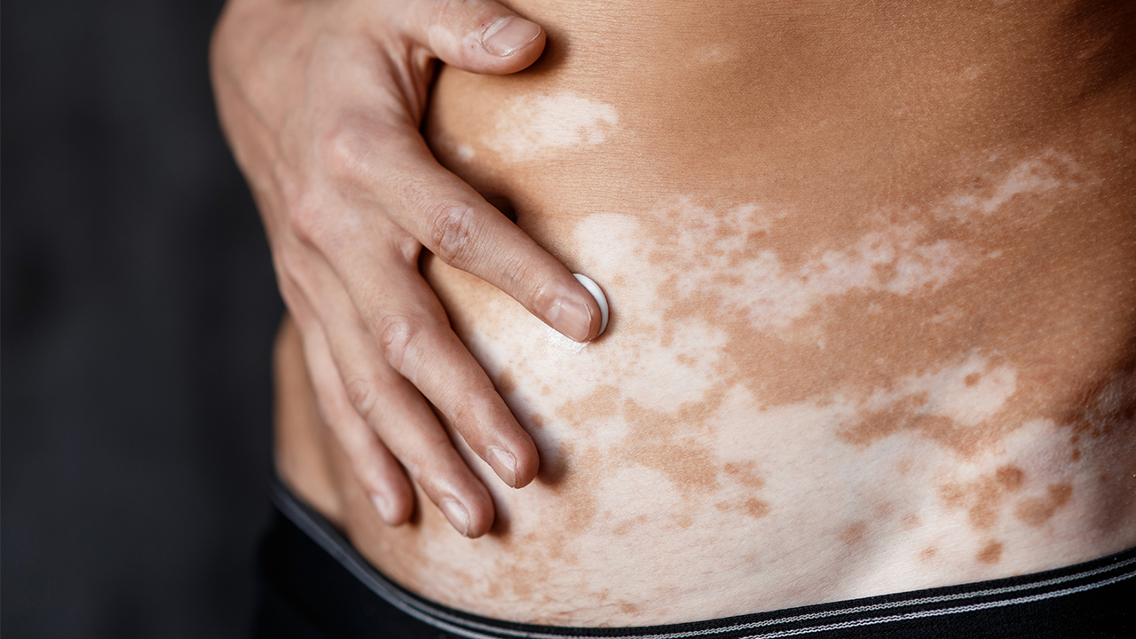 有白癜風(fēng)可以考公務(wù)員嗎