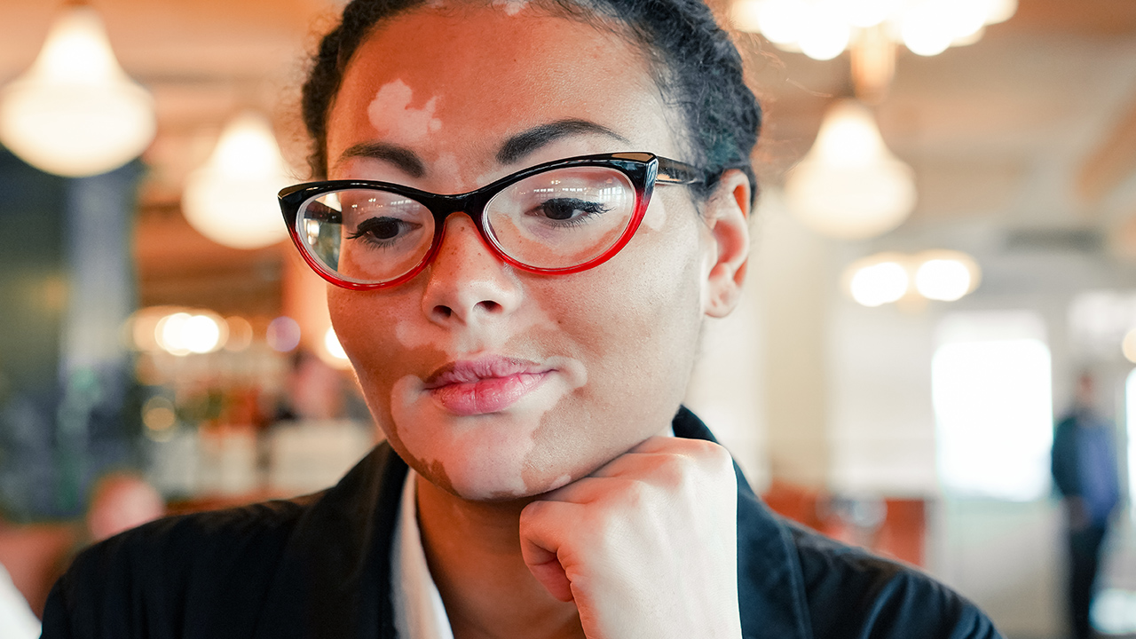 什么情況會誘發(fā)白癜風(fēng)的