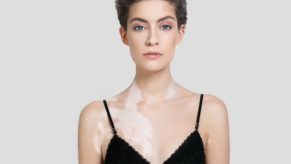 腳背上白癜風(fēng)有什么危害