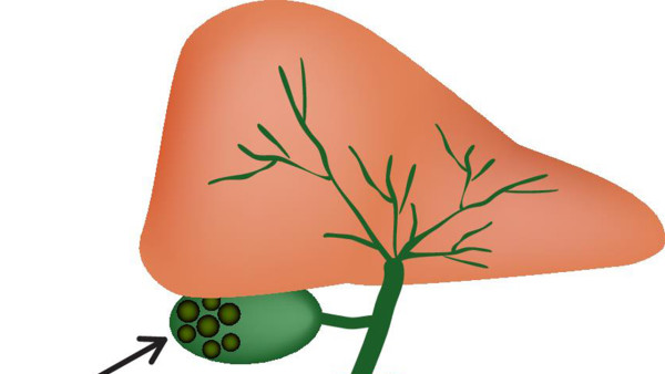 病毒性肝炎的典型癥狀是什么