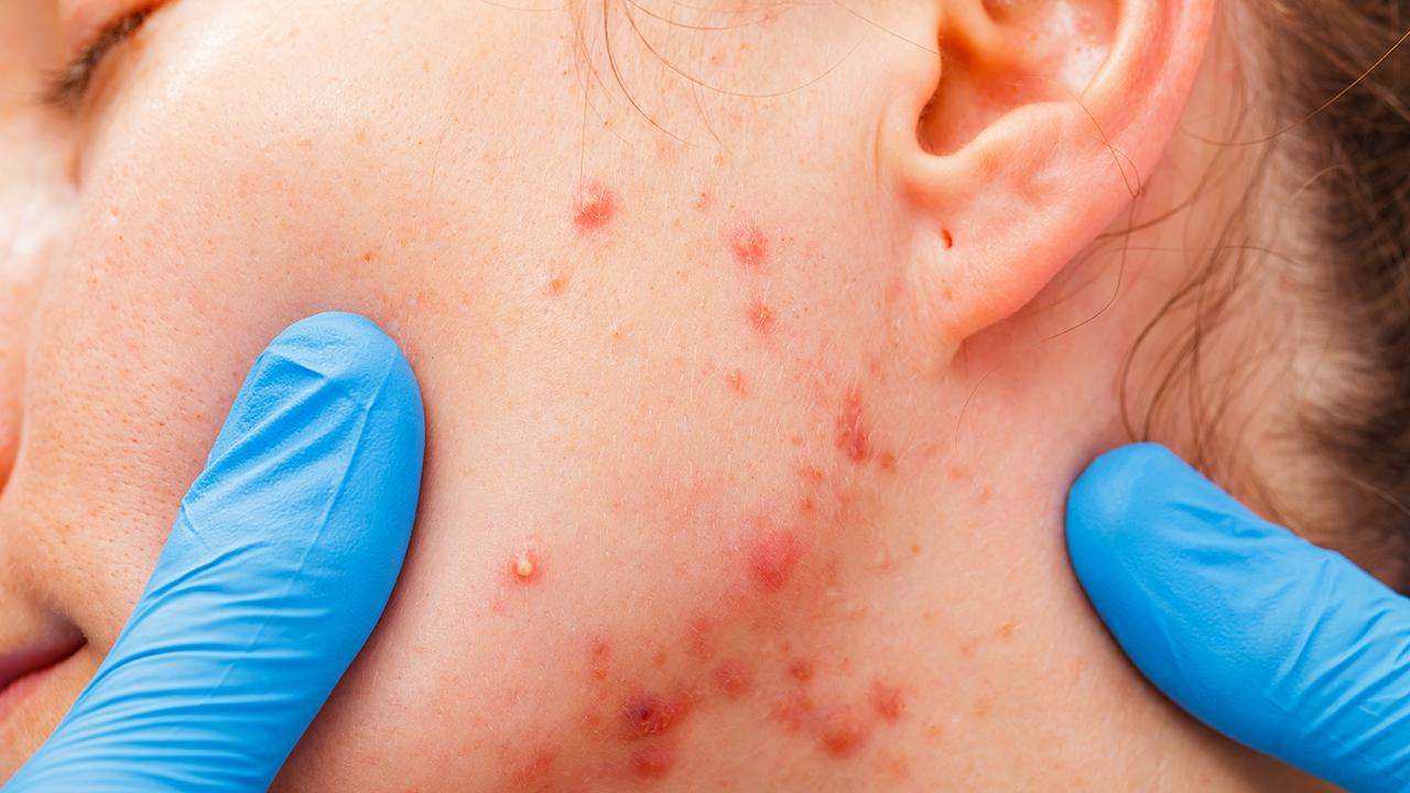 艾滋病患者護理注意事項