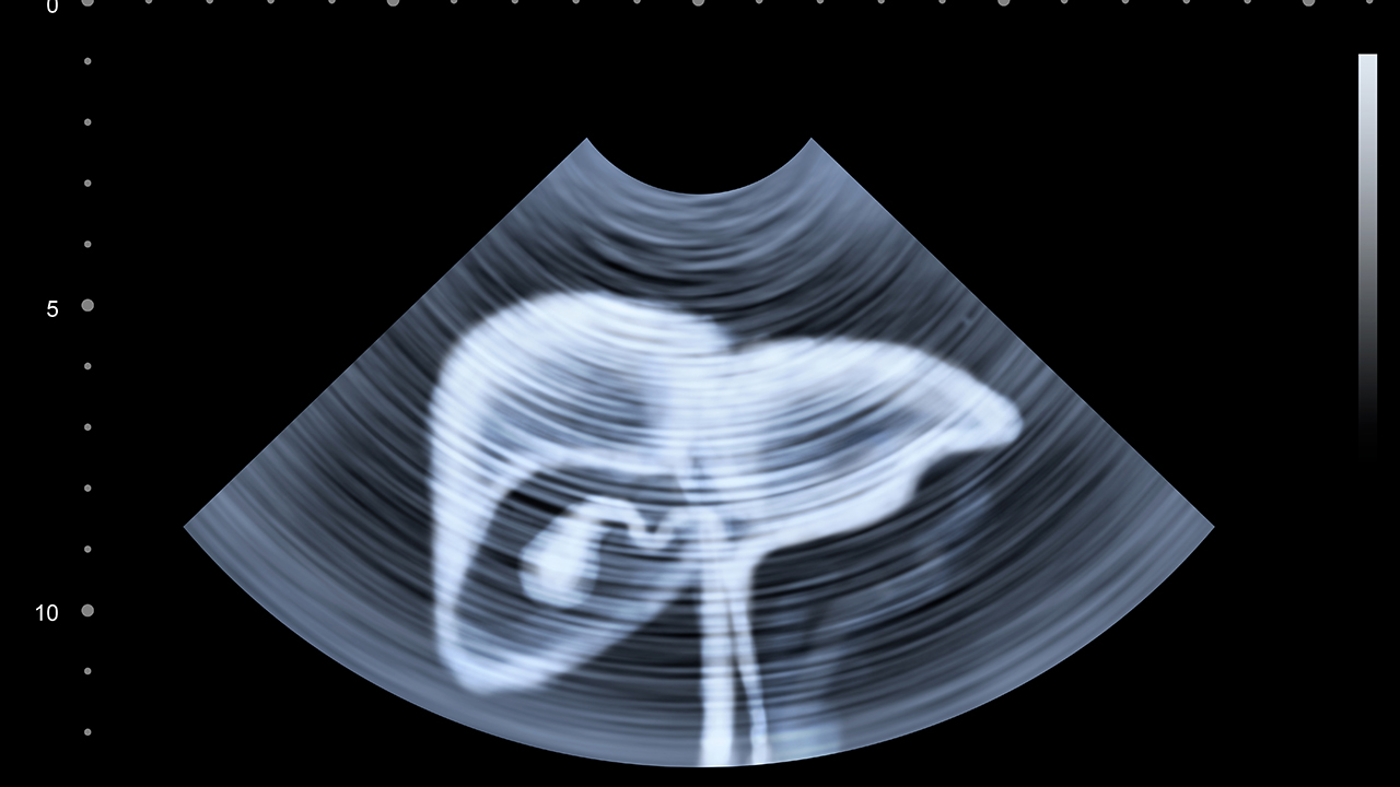 丙肝最佳治療方案 了解這些正確治療丙肝(2)