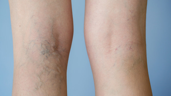 靜脈曲張能自愈嗎