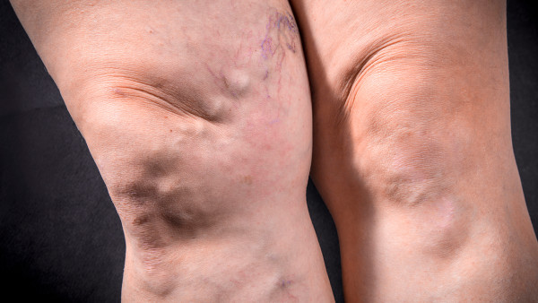 嚴(yán)重類風(fēng)濕怎么查得出來