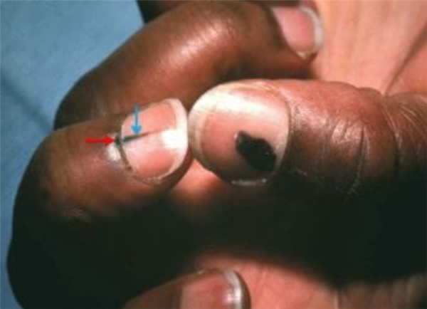指甲出現(xiàn)一條黑線 別不當(dāng)回事！可能是癌變