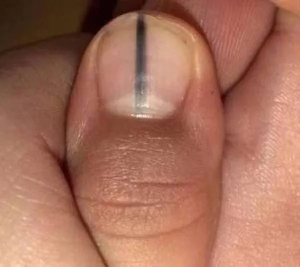 指甲出現(xiàn)一條黑線 別不當(dāng)回事！可能是癌變