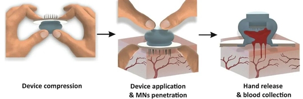 看到針頭就腿軟的人“有?！绷?！新型采血設(shè)備向水蛭取經(jīng)