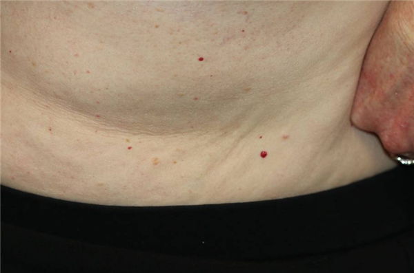 身上突然長(zhǎng)的小紅點(diǎn) 到底是什么東西??？會(huì)癌變嗎？