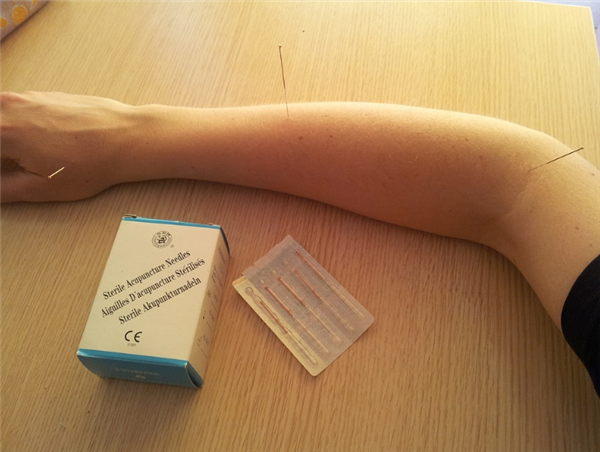 女子在養(yǎng)生館針灸肺被扎破：緊急手術(shù)放氣