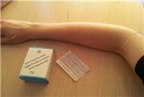 女子在養(yǎng)生館針灸肺被扎破：緊急手術(shù)放氣